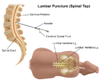 Illustration of lumbar puncture
