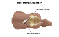  Illustration of a bone marrow aspiration procedure