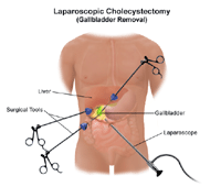 Illustration of laparoscopic cholecystectomy