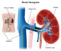 Illustration of renal venogram procedure