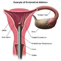Illustration of an endometrial ablation procedure