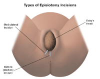 Illustration of an episiotomy procedure 