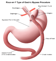 Illustration of a roux-en-Y gastric bypass procedure