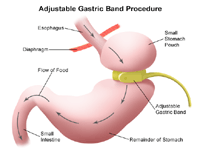 Illustration of a restrictive surgical procedure for weight loss