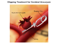 Illustration of clipping of cerebral aneurysm