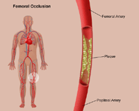 Illustration of femoral popliteal occlusion