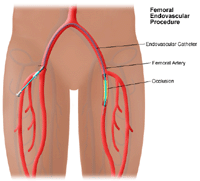 Illustration of femoral popliteal endovascular procedure