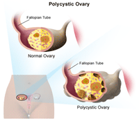 Illustration of a polycystic ovary