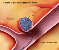 Illustration of coil procedure for intracranial aneurysm