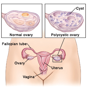 Outline of female pelvis showing vagina, uterus, fallopian tubes, and ovaries. Closeup of cross section of normal ovary. Closeup of cross section of polycystic ovary.