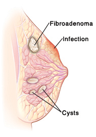 Cross section side view of breast showing fibroadenoma, infection, and cysts.