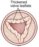 Top view of open pulmonary valve with thickened leaflets.