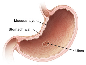 Cross section of stomach showing ulcer.