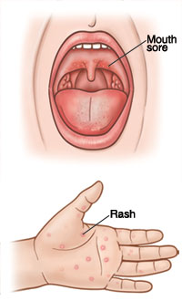 Open mouth showing sore on back of roof of mouth. Closeup of palm of hand showing red rash.