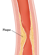 Cross section of artery with plaque in wall.