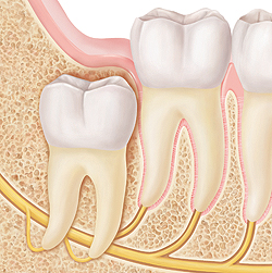 Teeth in cross section of jawbone. Wisdom tooth is in bone under gum, pointing straight upward.