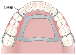 Roof of mouth and teeth showing partial denture. Clasp is around teeth. Metal framework is on roof of mouth. Framework holds replacement teeth.