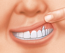Closeup of mouth with finger lifting upper lip to show uneven gumline.