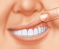 Closeup of mouth with finger lifting upper lip to show evened-out gumline after surgery.