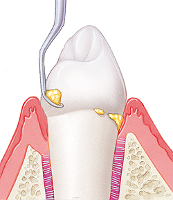 Tooth in cross section of gum and bone. Plaque on base and most of root of tooth. Gum is swollen. Instrument is scraping plaque from lower part of  tooth.