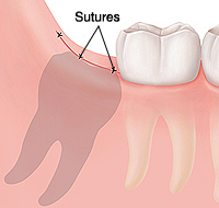 Closeup of gum and molars showing sutures closing gum where wisdom tooth was removed.