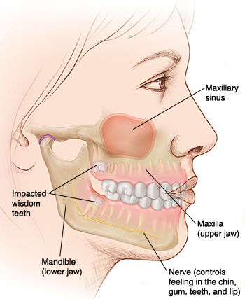 Side view of woman's face with teeth in jawbones visible. Mandible is lower jaw, maxilla is upper jaw. Maxillary sinus is in upper jaw. Nerve in mandible controls feeling in chin, gum, teeth, lip. Wisdom teeth in upper and lower jaws are impacted.