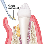 Tooth in cross section of gum and bone. Flap of gum exposes root of tooth and eroded bone. Instrument is placing graft material between bone and tooth.