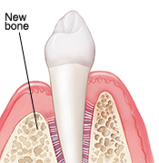 Tooth in cross section of gum and bone. New bone has grown where graft was placed.