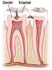Cross section of two teeth in jawbone. Enamel covers crown of tooth with dentin underneath. Tooth decay in top of tooth and between teeth.