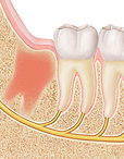 Closeup cross section of jawbone and molars showing repair tissue where wisdom tooth was removed.