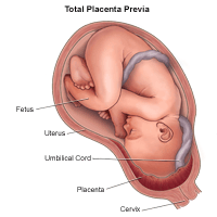 Illustration demonstrating total placenta previa