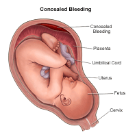 Illustration demonstrating concealed bleeding during pregnancy