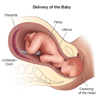 Illustration of the delivery of the baby 