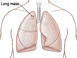 Front view of chest showing lungs with mass on right lung.