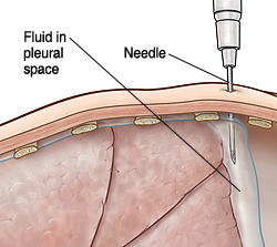 Percutaneous Diagnosis of Chest, Lung Problems