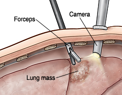 Cross section of body wall showing camera inserted in chest while forceps take sample from lung mass.