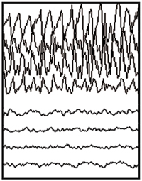 Normal EEG tracing.