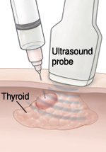 Ultrasound probe on neck and needle in nodule on thyroid gland.