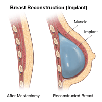 Illustration of a breast side view, before and after reconstruction (Implant)