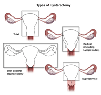 Illustration of the different types of hysterectomy