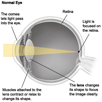 Cross section of eye showing light focusing on retina normally.