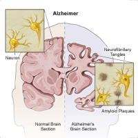 Illustration showing how alzheimer affects the brain