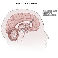 Illustration of Parkinson's disease effect on the brain