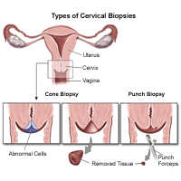 Illustration of a cervical biopsy procedure
