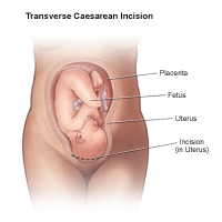 Illustration of a transverse cesarean incision