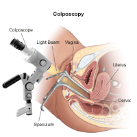 Illustration of a colposcopy procedure