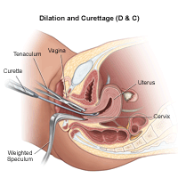 Illustration of a dilation and curettage procedure