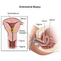 Illustration of an endometrial biopsy procedure