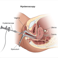 Illustration of a hysteroscopy procedure
