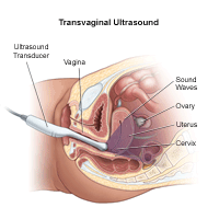 Illustration of transvaginal ultrasound procedure